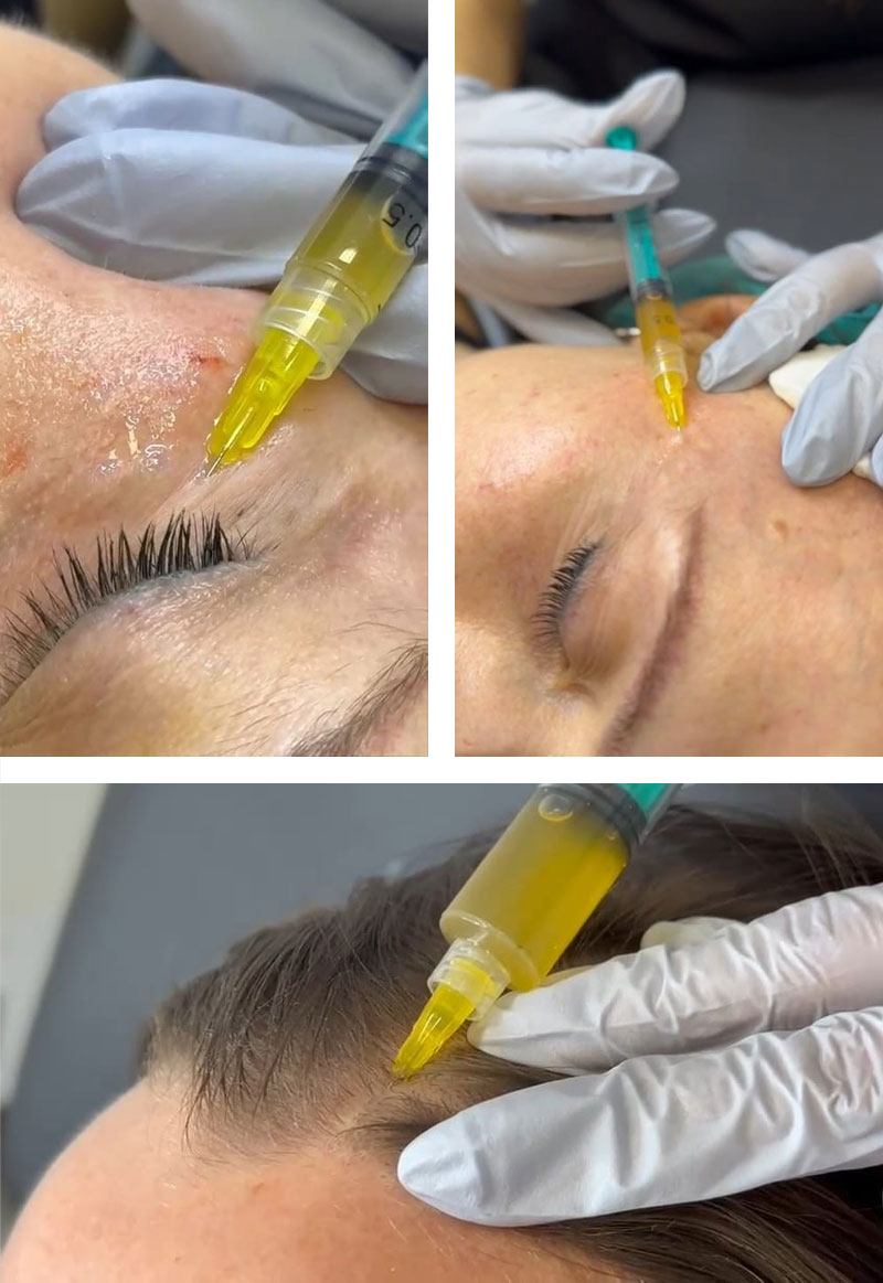 Fibryna bogatopłytkowa Lublin Fibryna bogatopłytkowa Lublin