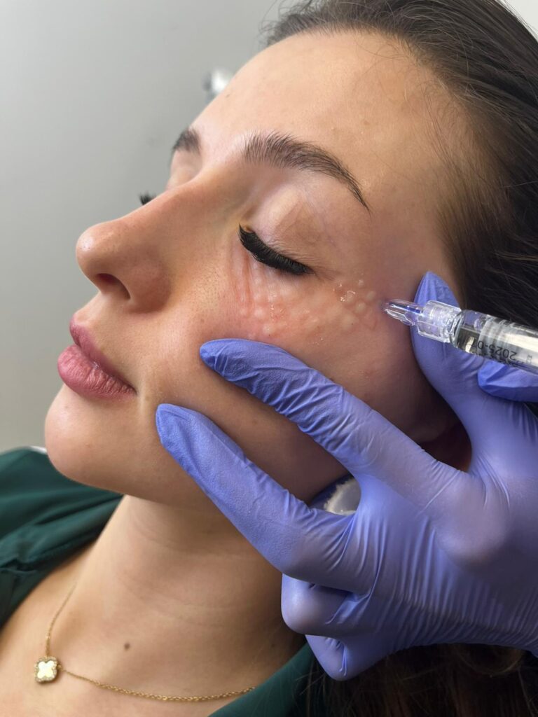 Medycyna Estetyczna Lublin kwas polimlekowy stymulatory Lublin